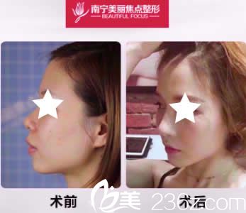 南寧美麗焦點(diǎn)焦俊光院長(zhǎng)鼻綜合案例