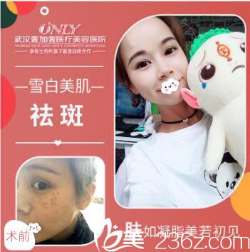 武漢壹加壹醫(yī)療美容醫(yī)院楊麗萍激光祛斑案例效果對比圖