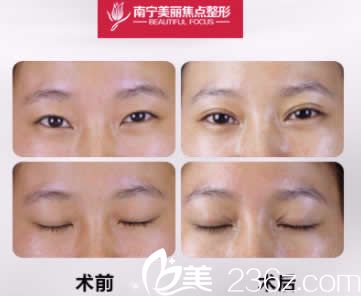 南寧美麗焦點(diǎn)雙眼皮整形失敗修復(fù)案例