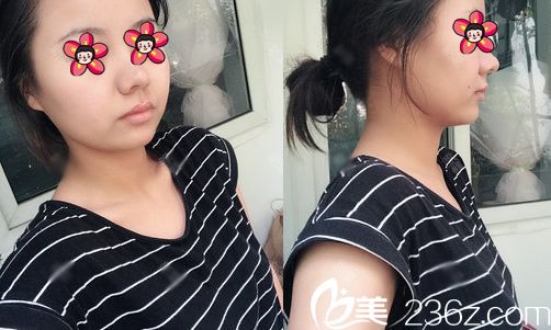 在溫州藝星做假體隆胸手術(shù)前 在溫州藝星做假體隆胸手術(shù)前