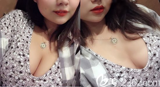 做完假體隆胸手術(shù)45天恢復(fù)照 做完假體隆胸手術(shù)45天恢復(fù)照