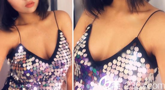 溫州藝星譚立文假體隆胸案例70天效果 溫州藝星譚立文假體隆胸案例70天效果