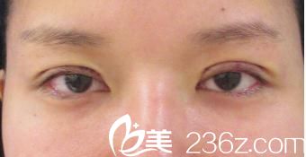 日本東京ISEA整形美容醫(yī)院全切雙眼皮開眼角手術(shù)當(dāng)天