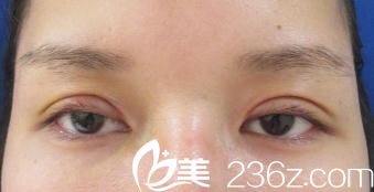 吉種克之全切雙眼皮開眼角手術(shù)一周后