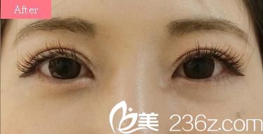 揭秘日式無痕雙眼皮真相，在東京ISEA整形外科醫(yī)院做了全切雙眼皮開眼角后感覺整個世界都變了