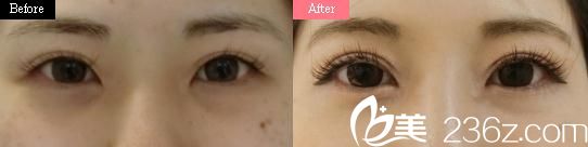 吉種克雙眼皮手術(shù)前后對比