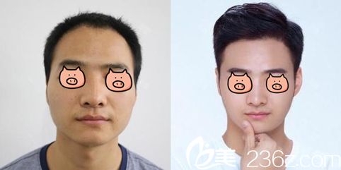 長沙藝星整形脂肪填充全臉案例