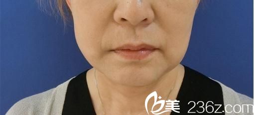 多大年紀(jì)適合做面部拉皮?60歲的我去日本東京ISEA整形外科醫(yī)院做面部提拉后變成了這個樣子