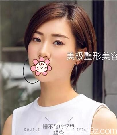 成都美極劉潔雙眼皮修復(fù)手術(shù)案例 成都美極劉潔雙眼皮修復(fù)手術(shù)案例
