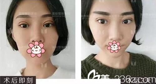 成都美極劉潔雙眼皮修復(fù)手術(shù)術(shù)后即刻 成都美極劉潔雙眼皮修復(fù)手術(shù)術(shù)后即刻