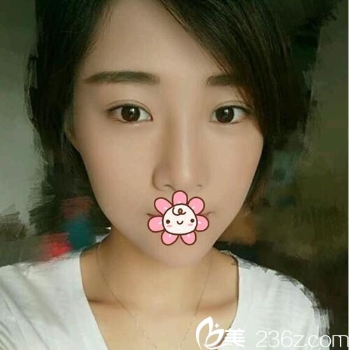 成都美極找劉潔雙眼皮修復(fù)案例：從睡不醒媽媽到辣媽的蛻變