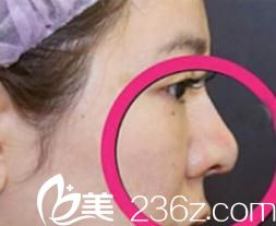 說說我前段時間在東京皮膚科形成外科醫(yī)院面診池田欣生后做的鼻尖形成術，從此做個鼻挺人