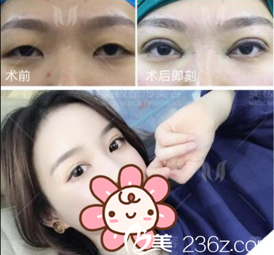 成都美極雙眼皮術(shù)前術(shù)后對(duì)比 成都美極雙眼皮術(shù)前術(shù)后對(duì)比
