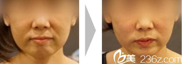 池田欣生面部埋線提升前后對比