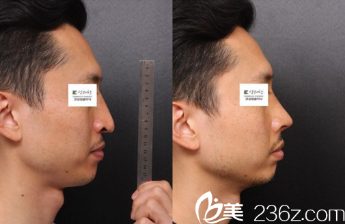 鼻整形真人前后對比效果