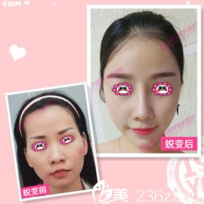 東方整形醫(yī)院隆鼻效果圖