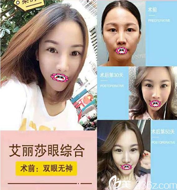 南寧東方整形醫(yī)院雙眼皮前后對比圖