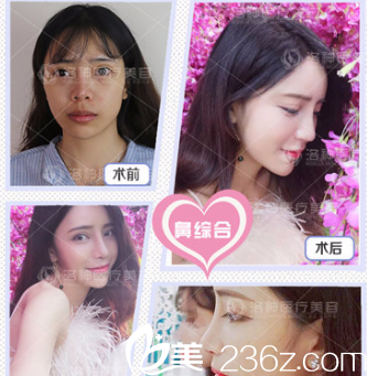 煙臺(tái)洛神隆鼻案例