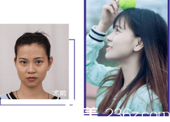 煙臺(tái)華怡隆鼻案例