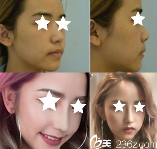 南寧夢(mèng)想整形鼻綜合前后對(duì)比圖