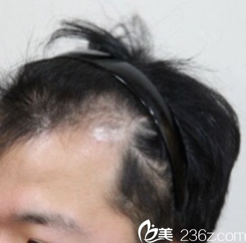 韓國(guó)江南NHI植發(fā)醫(yī)院種植發(fā)際線術(shù)前 韓國(guó)江南NHI植發(fā)醫(yī)院種植發(fā)際線術(shù)前