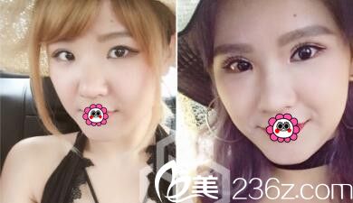 中國臺灣首席整形混血瞳手術案例