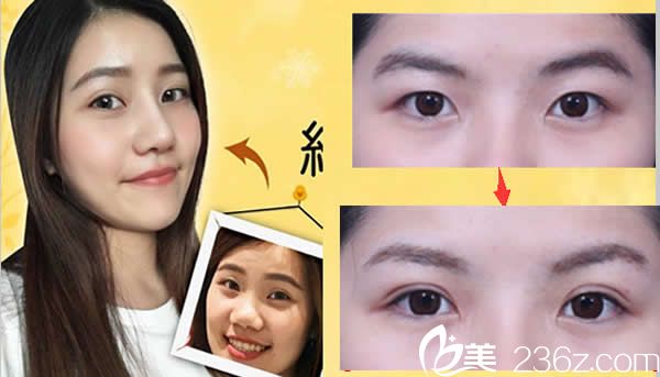 臺北慕顏自體軟骨綜合隆鼻+全切雙眼皮效果案例 臺北慕顏自體軟骨綜合隆鼻+全切雙眼皮效果案例