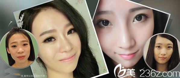 中國(guó)臺(tái)灣慕顏?lái)f志曄鼻綜合隆鼻案例 中國(guó)臺(tái)灣慕顏?lái)f志曄鼻綜合隆鼻案例