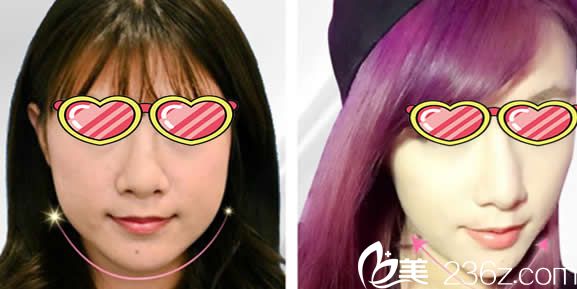 臺(tái)北慕顏整形郭姿廷醫(yī)生前后效果對(duì)比案例 臺(tái)北慕顏整形郭姿廷醫(yī)生前后效果對(duì)比案例