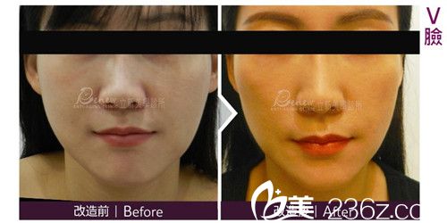 鄞愉文注射瘦臉案例效果圖 鄞愉文注射瘦臉案例效果圖