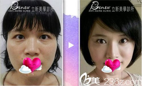 中國臺灣鄞愉文線雕提拉案例對比 中國臺灣鄞愉文線雕提拉案例對比