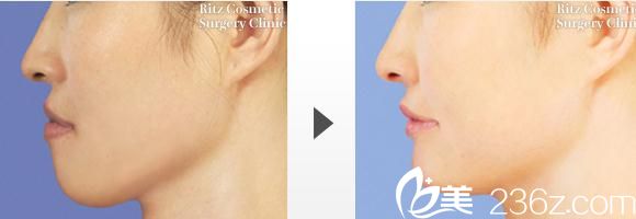 廣比利次醫(yī)生下顎前凸削骨手術(shù)前后對(duì)比 廣比利次醫(yī)生下顎前凸削骨手術(shù)前后對(duì)比
