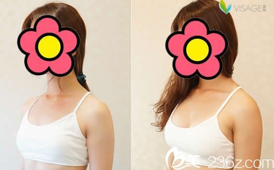 臺北慕顏整形胡岱霖內窺鏡果凍隆胸效果怎么樣 臺北慕顏整形胡岱霖內窺鏡果凍隆胸效果怎么樣