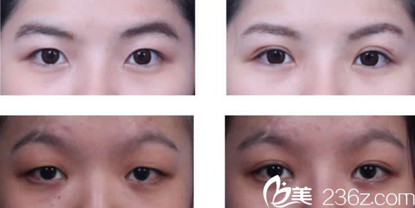 慕顏美學診所余德毅全切雙眼皮+開眼角三個月效果 慕顏美學診所余德毅全切雙眼皮+開眼角三個月效果