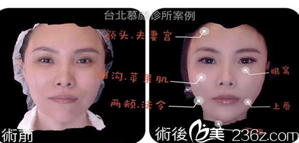 北慕顏整形醫(yī)院張至德醫(yī)生自體脂肪面部填充效果案例 北慕顏整形醫(yī)院張至德醫(yī)生自體脂肪面部填充效果案例