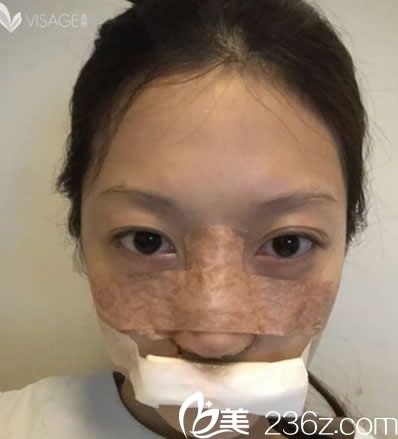 臺(tái)北慕顏假體隆鼻+耳軟骨墊鼻尖天 臺(tái)北慕顏假體隆鼻+耳軟骨墊鼻尖天