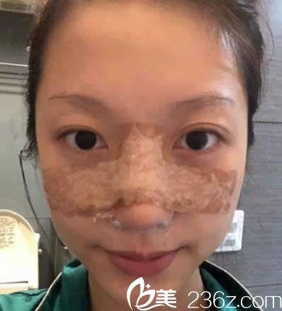 鼻綜合隆鼻第二天效果 鼻綜合隆鼻第二天效果