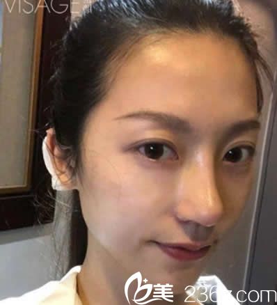 臺(tái)北慕顏整形鼻綜合隆鼻第七天拆線后 臺(tái)北慕顏整形鼻綜合隆鼻第七天拆線后