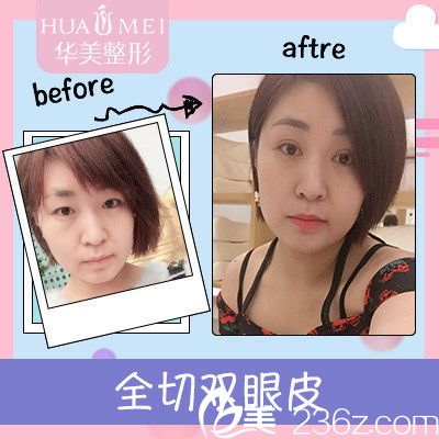 汕頭華美蔣友寧雙眼皮案例