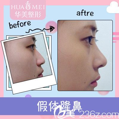 汕頭華美田學勤隆鼻案例