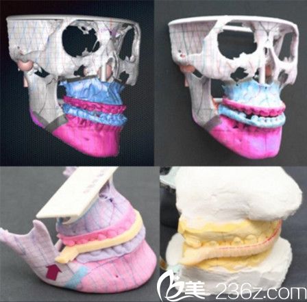 bos system輪廓整形系統(tǒng)技術(shù)