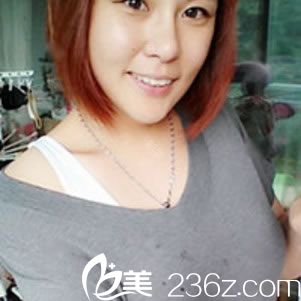 做完假體和脂肪隆胸8天恢復(fù)照