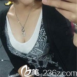 在紹興藝美整形這花3W多做假體和自體脂肪復合隆胸的這半年時間里,沒一天后悔過