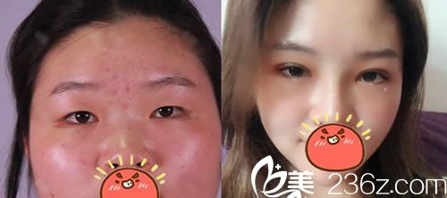 寧波113醫(yī)院整形科金式倫雙眼皮案例