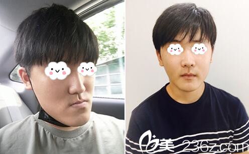 韓國(guó)NOW美口腔鄂頜面外科醫(yī)院雙鄂整形真人前后對(duì)比效果展示 韓國(guó)NOW美口腔鄂頜面外科醫(yī)院雙鄂整形真人前后對(duì)比效果展示