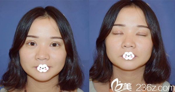 武漢壹加壹李艷東雙眼皮+開(kāi)眼角術(shù)后7天效果