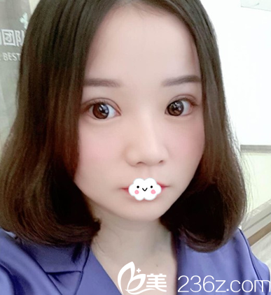 武漢壹加壹雙眼皮術(shù)后1月恢復(fù)照片