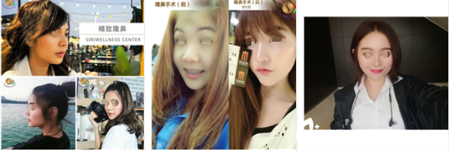 泰國SiriWellness Center(思麗)隆鼻案例 泰國SiriWellness Center(思麗)隆鼻案例