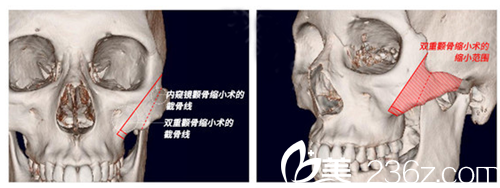 顴骨內(nèi)推 顴骨內(nèi)推