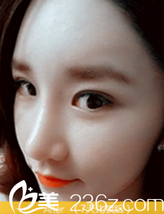 術(shù)后7天眼部變化情況 術(shù)后7天眼部變化情況